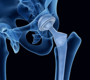 Hip replacement implant installed in the pelvis bone. X-ray view. Medically accurate 3D illustration